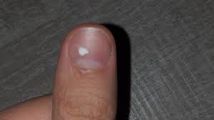 Les taches blanches sur les ongles, un manque de calcium? Faux