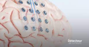 Un implant dans le cerveau pour bientôt? Oui et non