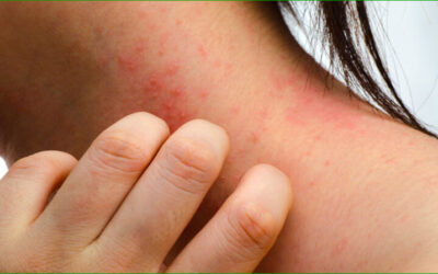 Eczéma : quel lien avec la symbolique psychologique et émotionnelle ?