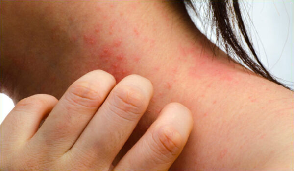 Eczéma : quel lien avec la symbolique psychologique et émotionnelle ?